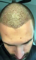 my 2024 journey for hair transplantation