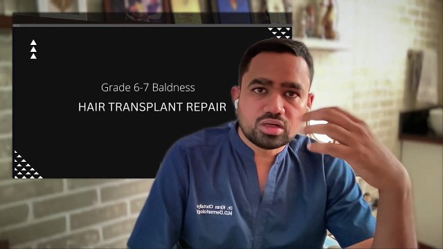 Hair Transplant in Pune _ Best Hair Transplant Results and Cost of Hair Transplant in Pune
