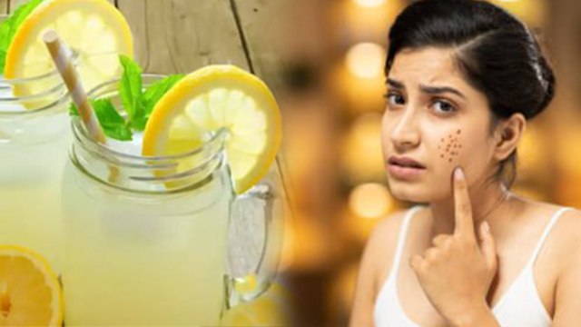 Lemon And Salt Face Acne Treatment: मुंहासों में नमक नींबू लगाने के फायदे, Namak Aur Nimbu Ke Fayde.