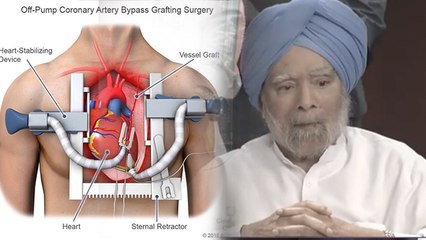 Former PM Dr. Manmohan Singh Underwent 5 Bypass Surgery क्या है, Process, Recovery & Risk Factors...
