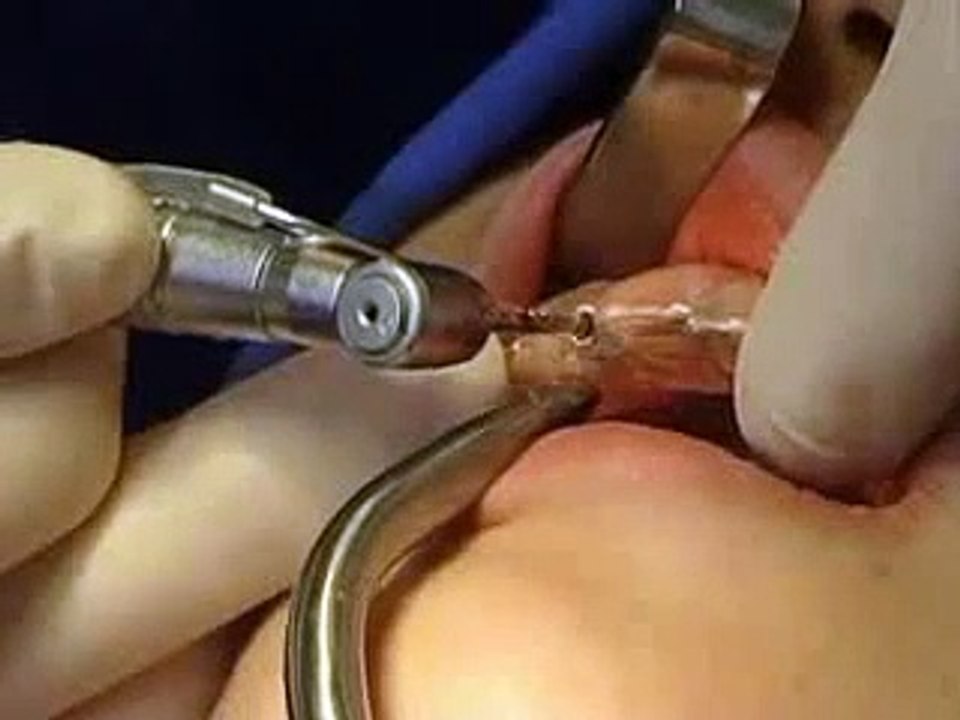 dental-implant-educational-video-from-dentalmumbai