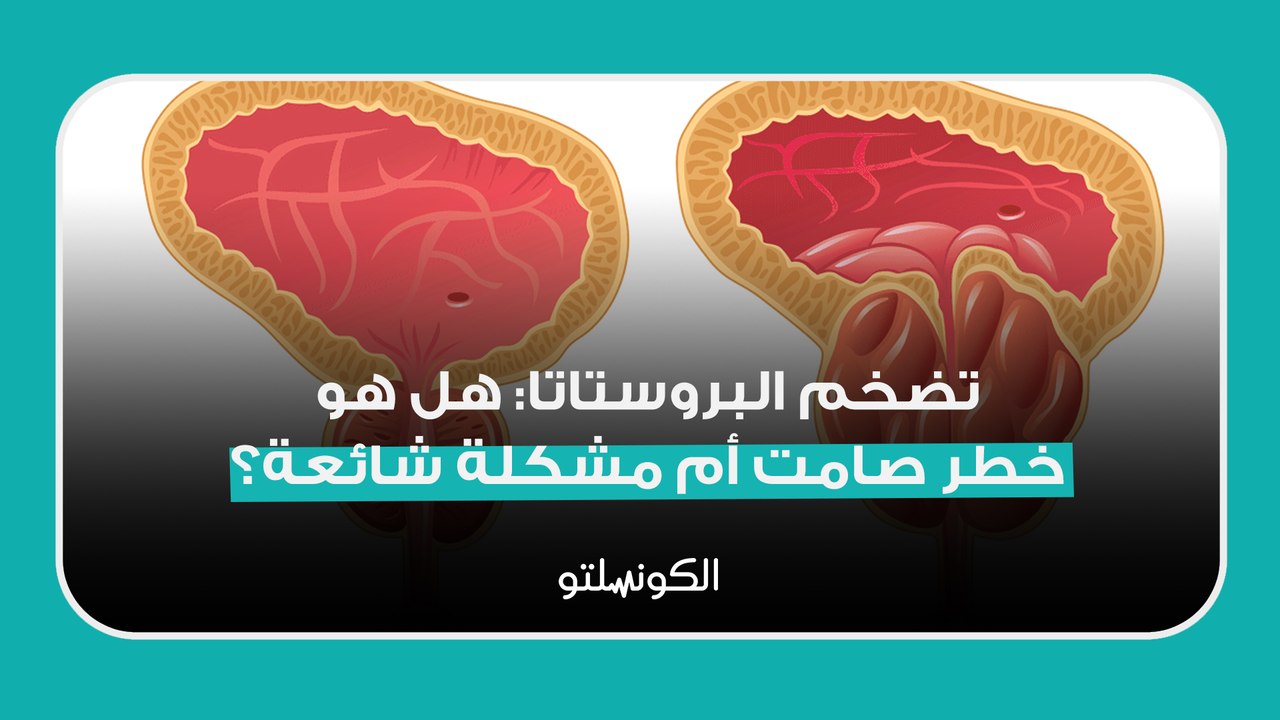 تضخم البروستاتا_ هل هو خطر صامت أم مشكلة شائعة؟