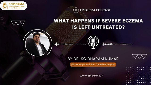 What Happens If Severe Eczema Is Left Untreated? | Dr. KC Dharam Kumar | Dermatologist in Jayanagar