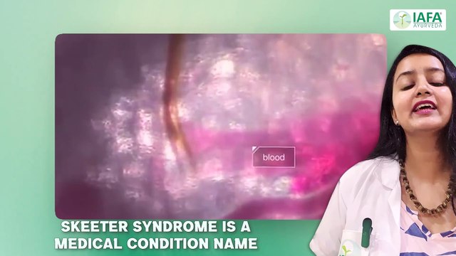 Skeeter Syndrome: Causes, Symptoms, Diagnosis, and Home Remedies