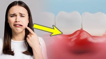 किस विटामिन की कमी से मसूड़ों में सूजन | Which Vitamin Deficiency Causes Gum Swelling|Boldsky