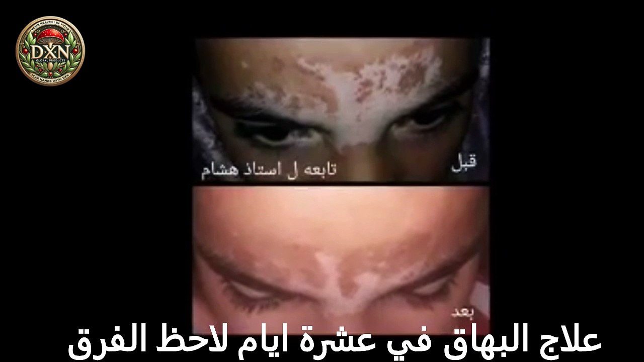 علاج البهاق في عشرة ايام لاحظ الفرق