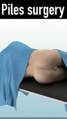 3d animation of Piles rubber band surgery