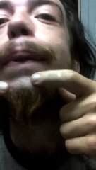 Stubborn mo-fu zit just doesnt want to pop on my upper chin near my lip on the left side