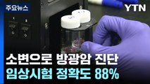 집에서 간편하게 소변으로 방광암 진단...초기 암까지 가능 / YTN