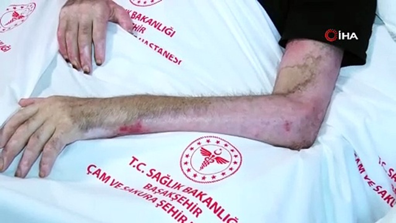 Mangal yapmak isterken dehşeti yaşadı! Tiner faciası kamerada: Vücudunun yüzde 80’i yandı