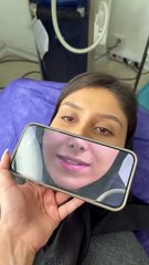 تزریق فیلر لب