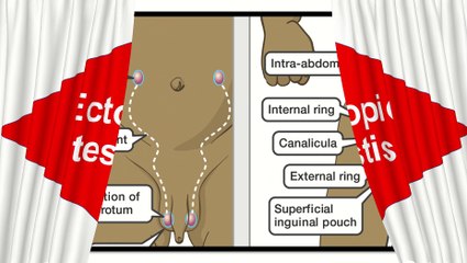 Ectopic testis