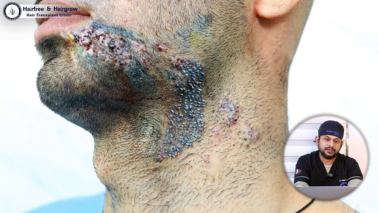 Best Hair Transplant in Bhopal | Hair Transplant Surgery and Hair Transplant Results in Bhopal