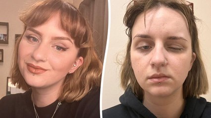 "My rare migraines give me a 'stroke' every two weeks"