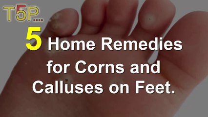 5 Home Remedies for Corns on Feet