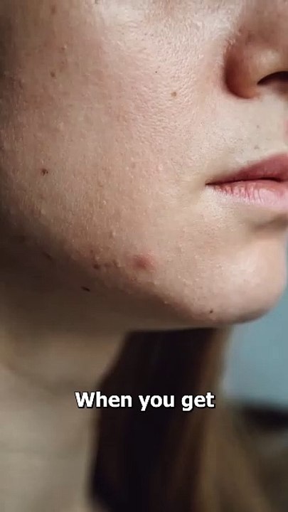 Should You Pop Your Pimples 🚫
