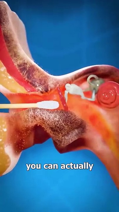 Why Q-Tips Are Bad 😨