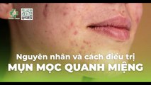 Mụn mọc quanh miệng: nguyên nhân và cách điều trị