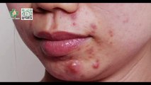 Hướng dẫn cách trị mụn mủ sưng to an toàn và hiệu quả