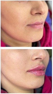 Your Trusted Destination for Dermal Fillers | Novin Ariana Clinic 💋