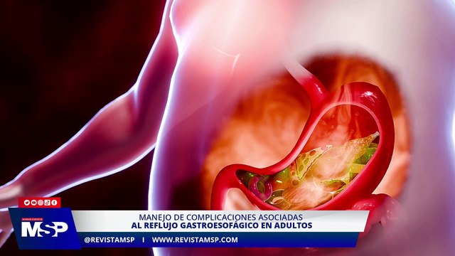 Manejo de complicaciones asociadas al reflujo gastroesofágico en adultos