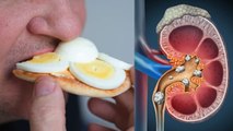 Eating Too Much Eggs Cause Kidney Stone|Jyada Anda Khane Ke Nuksan|ज्यादा अंडे खाने से क्या होता है