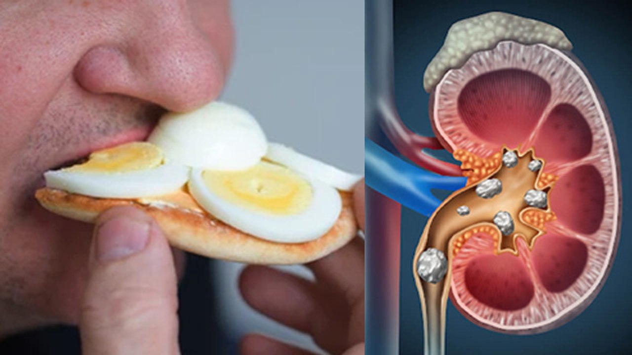 Eating Too Much Eggs Cause Kidney Stone|Jyada Anda Khane Ke Nuksan|ज्यादा अंडे खाने से क्या होता है