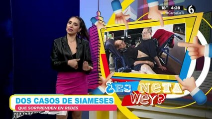 Caso de siameses que sorprende en redes sociales