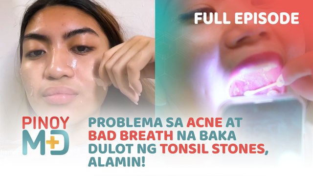 Solusyon sa acne at bad breath, alamin! (Full Episode) | Pinoy MD