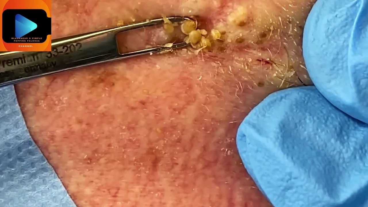 Amazing Blackhead Squeezing