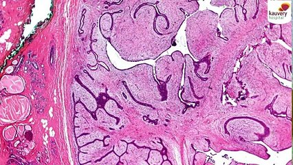 Phyllodes Tumor - Causes, Symptoms & Treatment