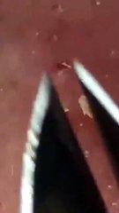 #acnetreatment #blackheads #satisfying #skincare #tweezers #角栓 #ピンセット