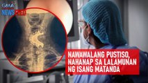 Nawawalang pustiso, nahanap sa lalamunan ng isang matanda | GMA Integrated Newsfeed