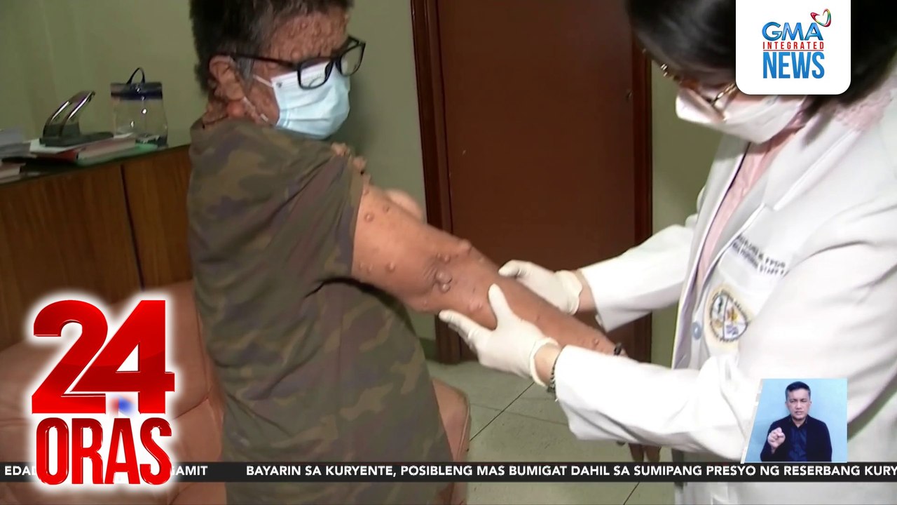 Magkapatid na tinubuan ng maliliit na bukol sa iba't ibang bahagi ng ...