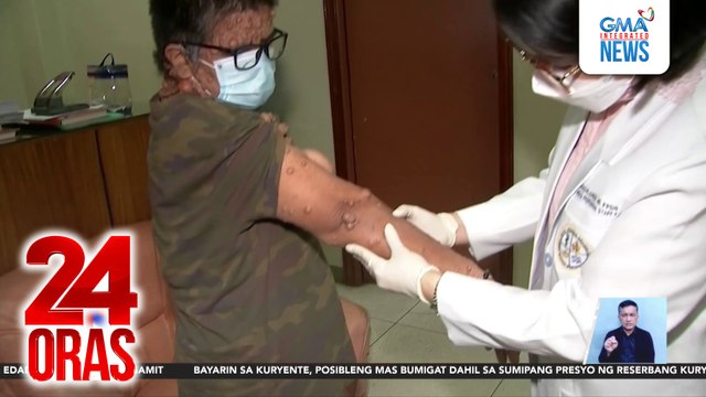 Magkapatid na tinubuan ng maliliit na bukol sa iba't ibang bahagi ng katawan, papa-operahan ng GMA Kapuso Foundation | 24 Oras