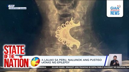 81-anyos na lalaki sa Peru, nalunok ang pustiso habang inaatake ng epilepsy | SONA