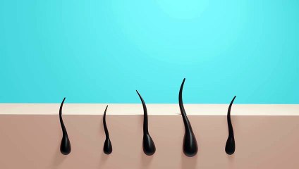Hair Patch vs. Hair Transplant: Which is Right for You?