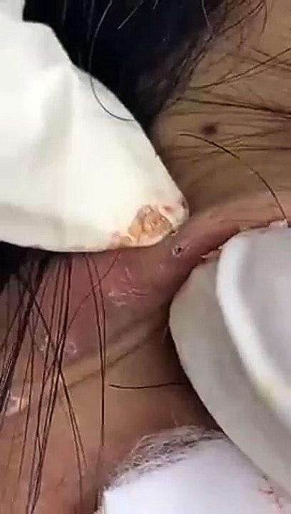 Big Cystic Acne Blackheads Extraction Blackheads & Milia, Whiteheads Removal Pimple Popping