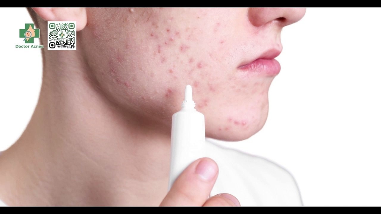 Bôi thuốc trị mụn đúng cách: hướng dẫn từ A - Z cho làn da sạch mụn