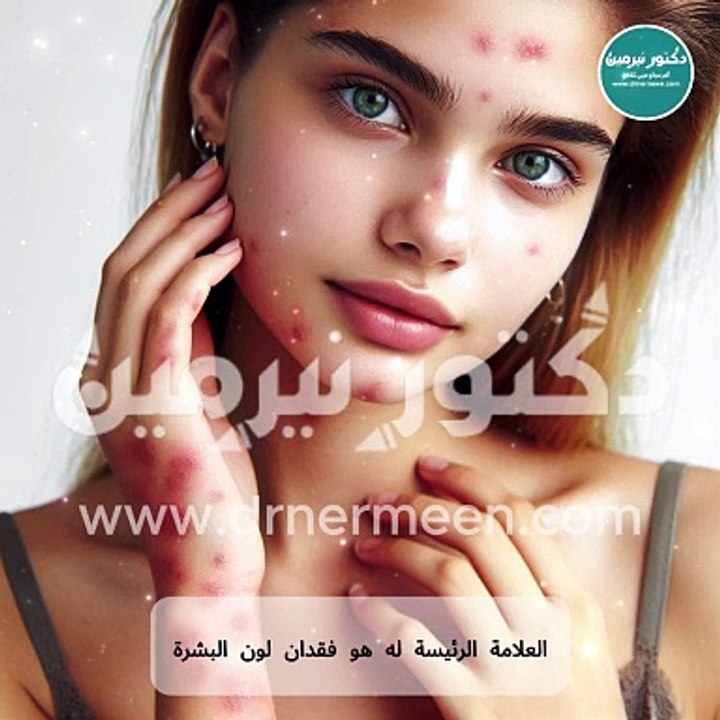 أعراض البهاق في الجسم #اعراض #عرض #مرض #بهاق #البهاق #امراض_جلدية #الجلد #النمش #حبوب #جلدية