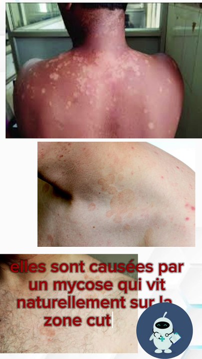 Le Pityriasis Versicolor