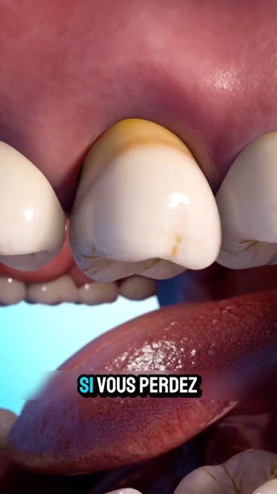 Si tu perds une dent