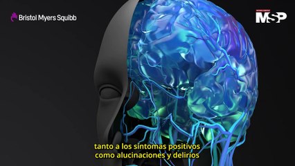 Un nuevo avance en el tratamiento de los síntomas negativos de la esquizofrenia