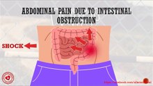 Abdominal pain due to intestinal obstruction