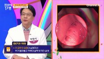 ↖위 건강이 곧 장 건강↗ 내시경으로 구별이 안되는 위궤양 VS 위암♨