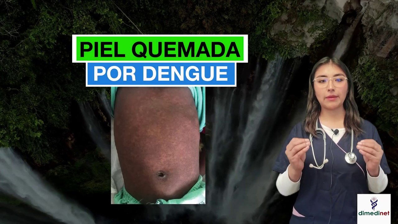 🟢 PIEL “OSCURECIDA” POR DENGUE Y QUE HACER AL RESPECTO