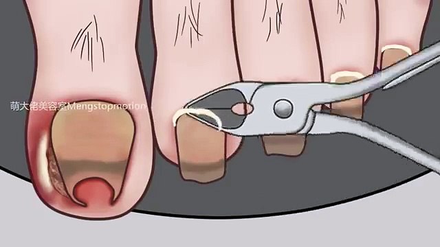 ASMR Body Treatments! Navel Stone, Ingrown Toenail, Ear Cleaning, Blackheads | Meng s Stop Motion