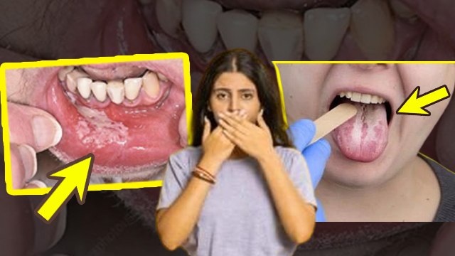 Mouth Fungal Infection Symptoms: मुंह में फंगल इन्फेक्शन क्यों होता है, कारण और बचाव | Boldsky