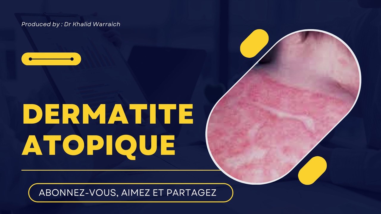 ✅Dermatite atopique. ✅ Expliqué par le Dr K Warraich ✅
