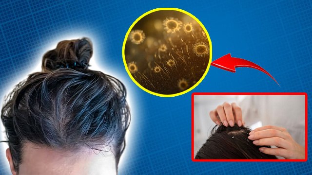 Oily Dandruff Scalp Treatment At Home: Kaise Hataye, Remedies In Hindi | Boldsky